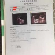 胎儿心管搏动是什么（怀孕50天，胎儿心跳搏动113次/分，正常吗）