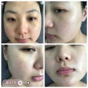 孕期如何祛斑（我怀孕初期脸上就长斑了，请问孕妇想祛斑可以用祛斑霜吗）