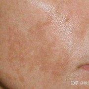 孕期脸上的斑怎么去除（孕期脸上的斑怎么去除小妙招）