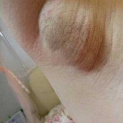 有没有孕期腋下变得很黑，或哪些部位变黑的,孕期腋下疼是怎么回事