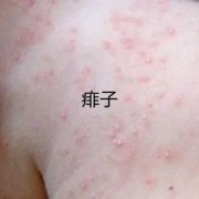 孕期为什么容易得湿疹（孕妇出湿疹怎么办）