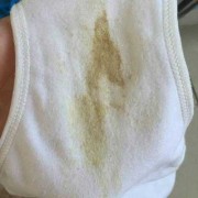 怀孕期间白带异常（怀孕期间白带不正常）