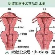 孕期阴道松弛（孕期阴道松弛）