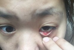 眼睛下眼睑长了个脓包，如果孕妇这样的话是什么原因呢?应该怎么办呢,孕期上眼皮肿了是怎么回事