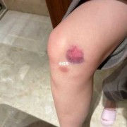 孕期摔倒（孕期摔倒屁股着地,对胎儿有没有影响）