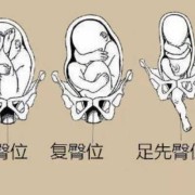 胎儿 臀位（胎儿臀位是什么姿势图）