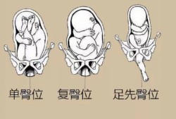 胎儿 臀位（胎儿臀位是什么姿势图）