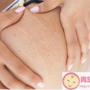 孕期肚脐周围发黑（生完宝宝后肚皮和肚脐都变黑了，该怎么办）