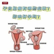 子宫肌瘤影响胎儿吗（孕妇子宫肌瘤影响胎儿吗）