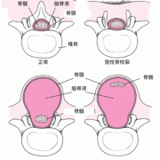 什么是胎儿脊柱裂,孕期脊柱疼怎么回事