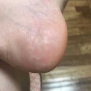 孕期脚很痒怎么办,孕期脚热怎么办快速缓解