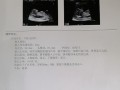 怀孕一个月发烧对胎儿有影响吗（怀孕一个月发烧对胎儿有影响吗）