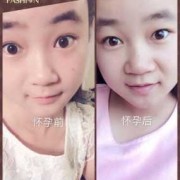 为什么怀孕鼻子会变大,孕期鼻子变大能恢复吗图片