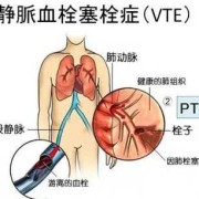 孕期静脉血栓（孕期静脉血栓）