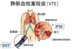 孕期静脉血栓（孕期静脉血栓）