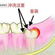孕妇得了智齿冠周炎，该如何治疗,孕妇冠周炎怎么办