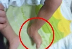 胎儿脑瘫吗（孕妇高潮宫缩会导致胎儿脑瘫吗）