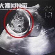 怀孕六个月胎儿趴着是什么原因,6个半月的胎儿图片大全