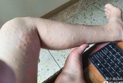 孕期湿疹怎么回事（孕期湿疹是什么引起的）