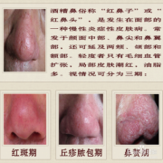 孕期红鼻头（鼻尖发红是什么原因）