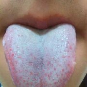 孕期舌苔发白（孕期舌苔发白）