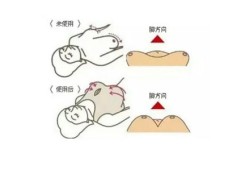 怀孕乳房下垂怎么纠正？方法是什么啊,孕期胸下垂正常吗