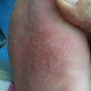 孕期脚底痒怎么回事（孕妇脚痒特别是晚上越抓越痒）