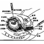 抽胎儿绒毛（抽取胎儿绒毛怎样抽取）