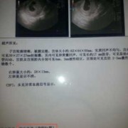 胎儿肾分离怎么吸收（怀孕七个月胎儿双肾集合系统分离是什么原因）