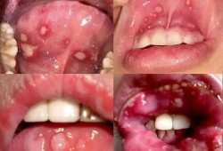 孕妇牙龈发炎怎么办,孕期牙龈问题怎么办