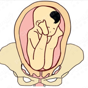 孕30周胎儿臀位还能自己转过来吗,怀孕30周胎儿发育图片