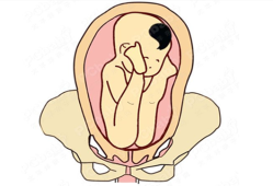 孕30周胎儿臀位还能自己转过来吗,怀孕30周胎儿发育图片
