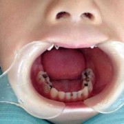 孕期蛀牙怎么办（孕期蛀牙怎么办才能治好）