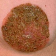 怀孕后乳头总是发痒，这是怎么回事呢,怀孕期间乳头痒怎么回事啊