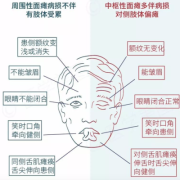 胎儿面瘫（面瘫对怀孕有影响吗）