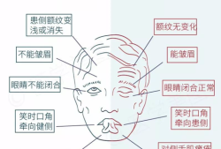 胎儿面瘫（面瘫对怀孕有影响吗）