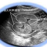 肾盂不分离是什么情况,胎儿肾盂无分离是男孩还是女孩
