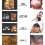 胎儿畸形彩超（四维彩超能检查出哪些畸形病呢）