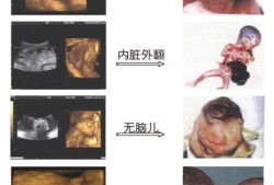 胎儿畸形彩超（四维彩超能检查出哪些畸形病呢）