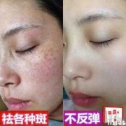孕期如何淡斑（孕期如何淡斑去黄）