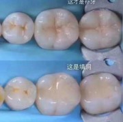 怀孕期间能补牙吗（怀孕期间能补牙吗有影响吗）