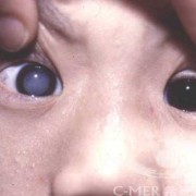 宝宝白内障能治愈吗,胎儿白内障能检查出来吗