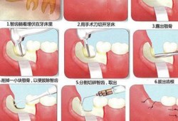 备孕期间可以拔智齿吗,怀孕期间能拔智齿吗用麻醉药品吗