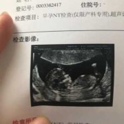孕期查nt主要查什么的（孕妇做nt检查多少钱，NT检查是检查什么的）