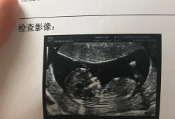 孕期查nt主要查什么的（孕妇做nt检查多少钱，NT检查是检查什么的）
