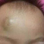 胎儿头皮水肿什么原因（宝宝头碰了个包怎么消肿）