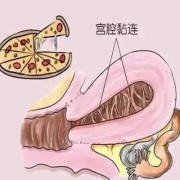 怀孕期间宫腔粘连带（怀孕期间宫腔粘连带怎么办）