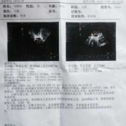 心脏超声检查多少钱,胎儿心脏筛查多少钱一次