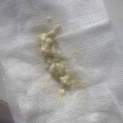 孕期白色白带（孕期白色的分泌物是什么）