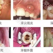 孕期牙齿坏了怎么办,孕期根管治疗危害
